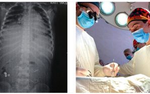 В Івано-Франківську врятували 7-річного хлопчика після того, як він проковтнув&hellip;